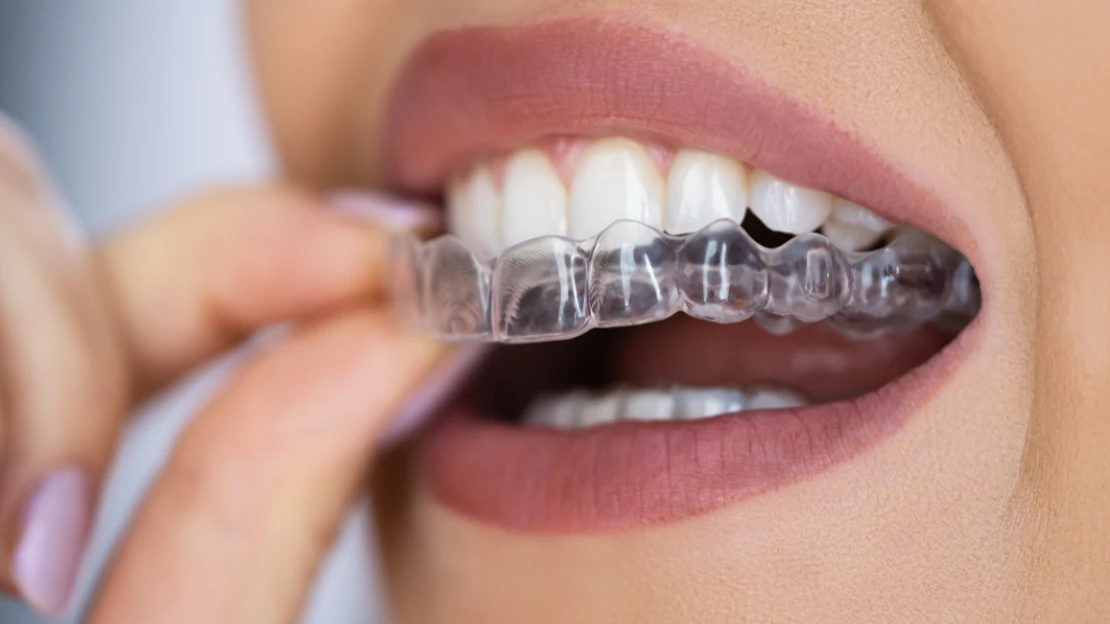 SEO Blog Invisalign Treat